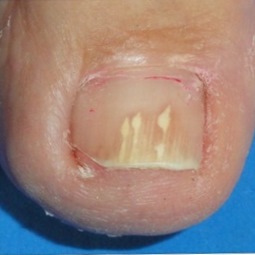 fungal toenail infection 1